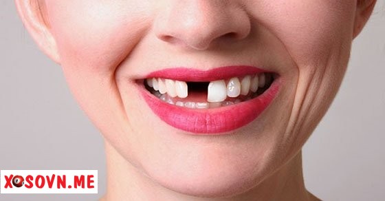 Mơ thấy rụng một chiếc răng – Chiêm bao thấy rụng một chiếc răng đánh con gì?